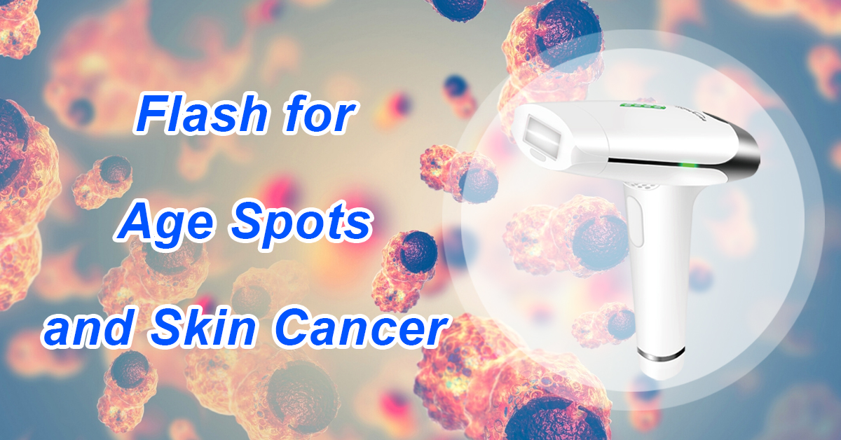 Flash for Age Spots and Skin Cancer