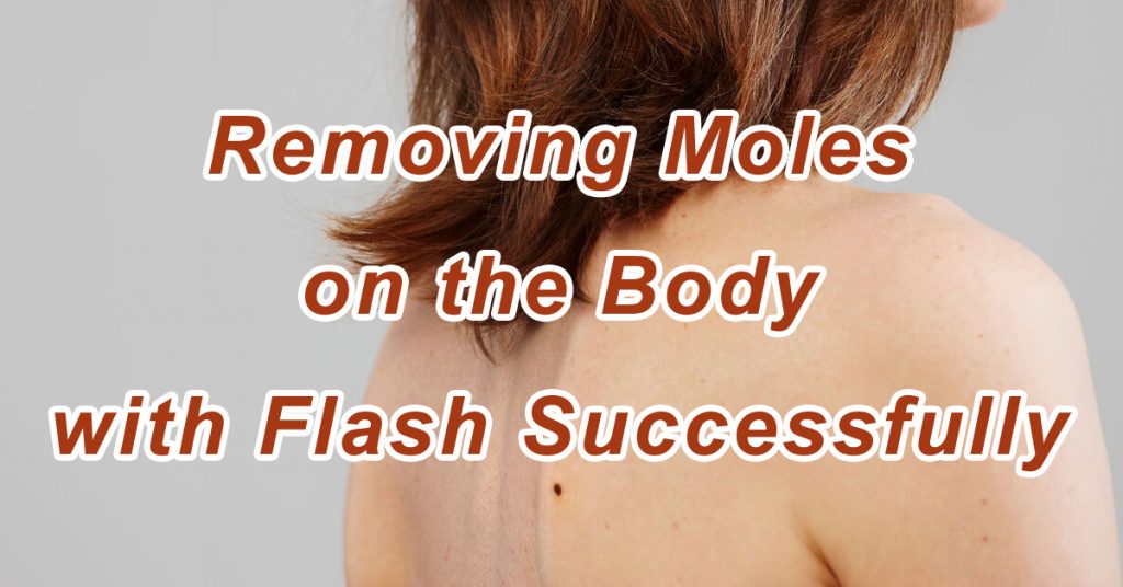 Removing Moles on the Body with Flash Successfully