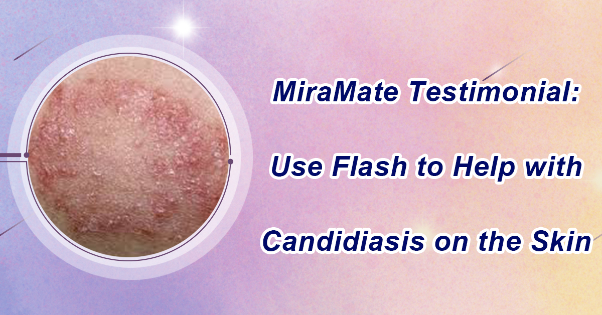 Use Flash to Help with Candidiasis on the Skin