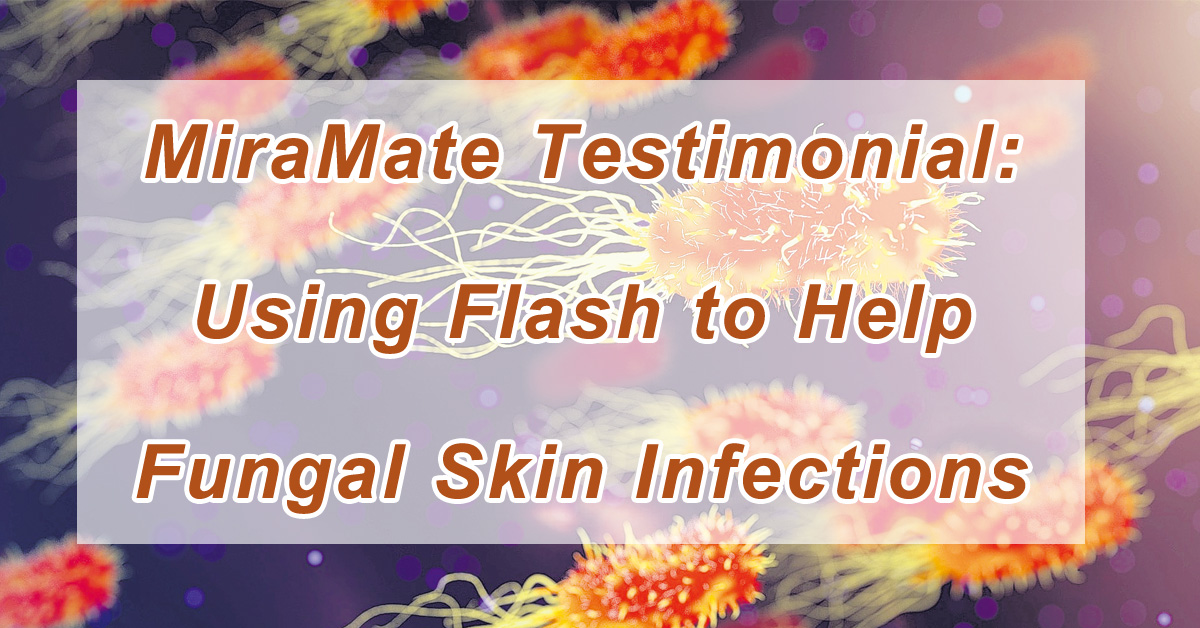 Using Flash to Help Fungal Skin Infections