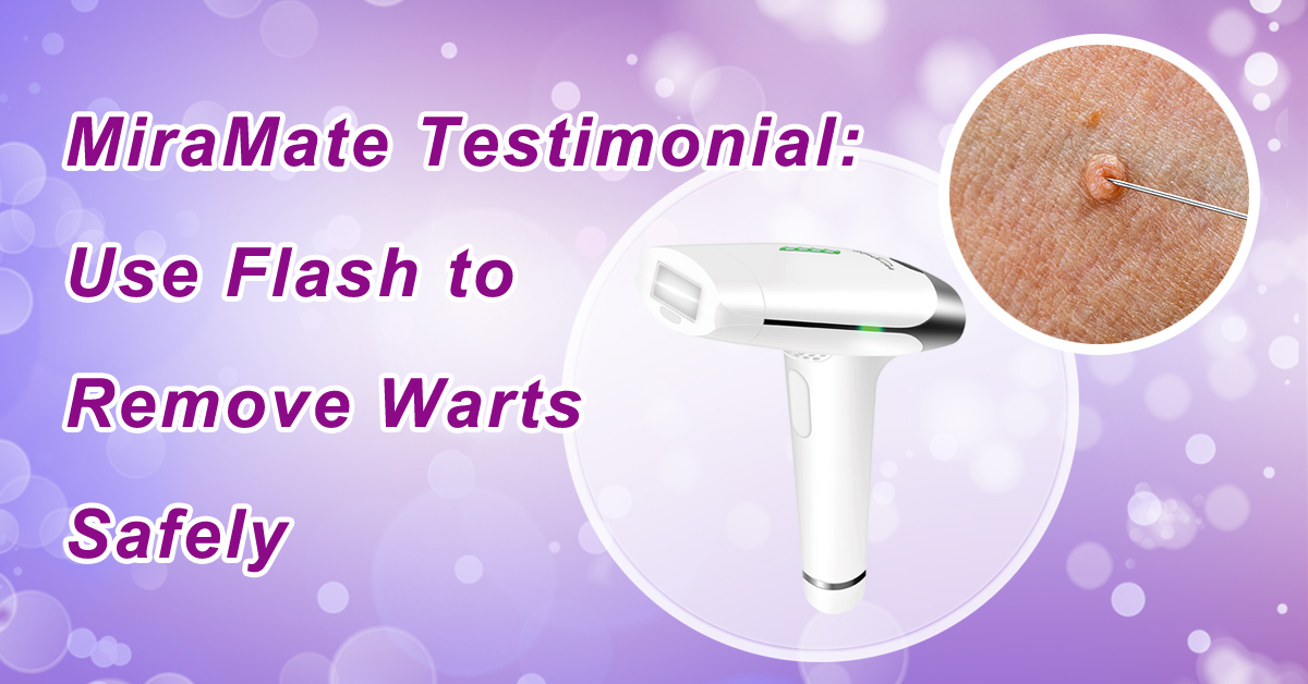 Use Flash to Remove Warts Safely