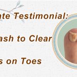 Use Flash to Clear Fungus on Toes