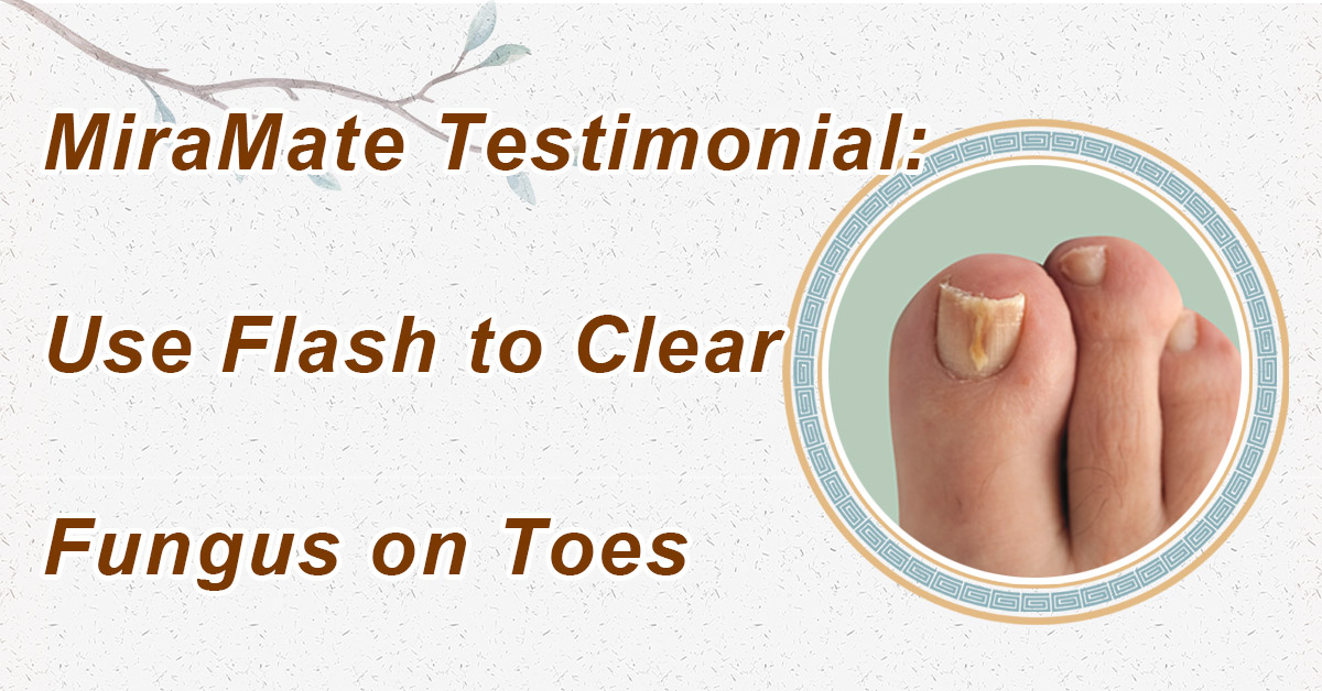 Use Flash to Clear Fungus on Toes