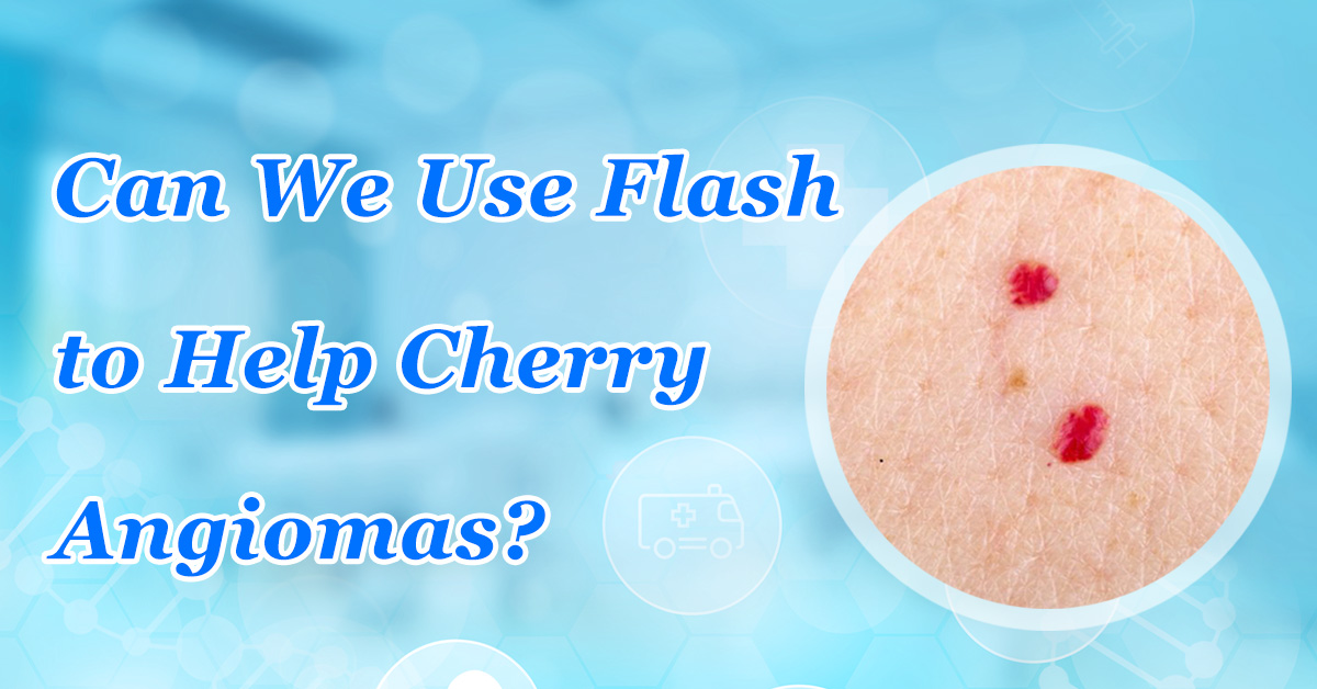 Can We Use Flash to Help Cherry Angiomas