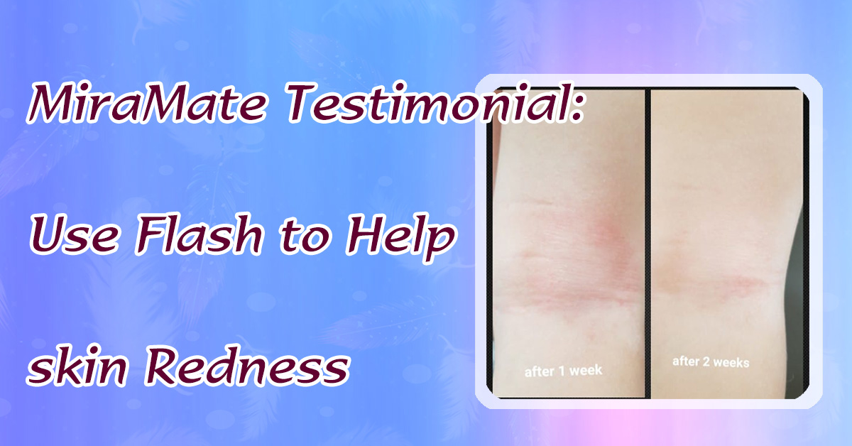 Use Flash to Help skin Redness