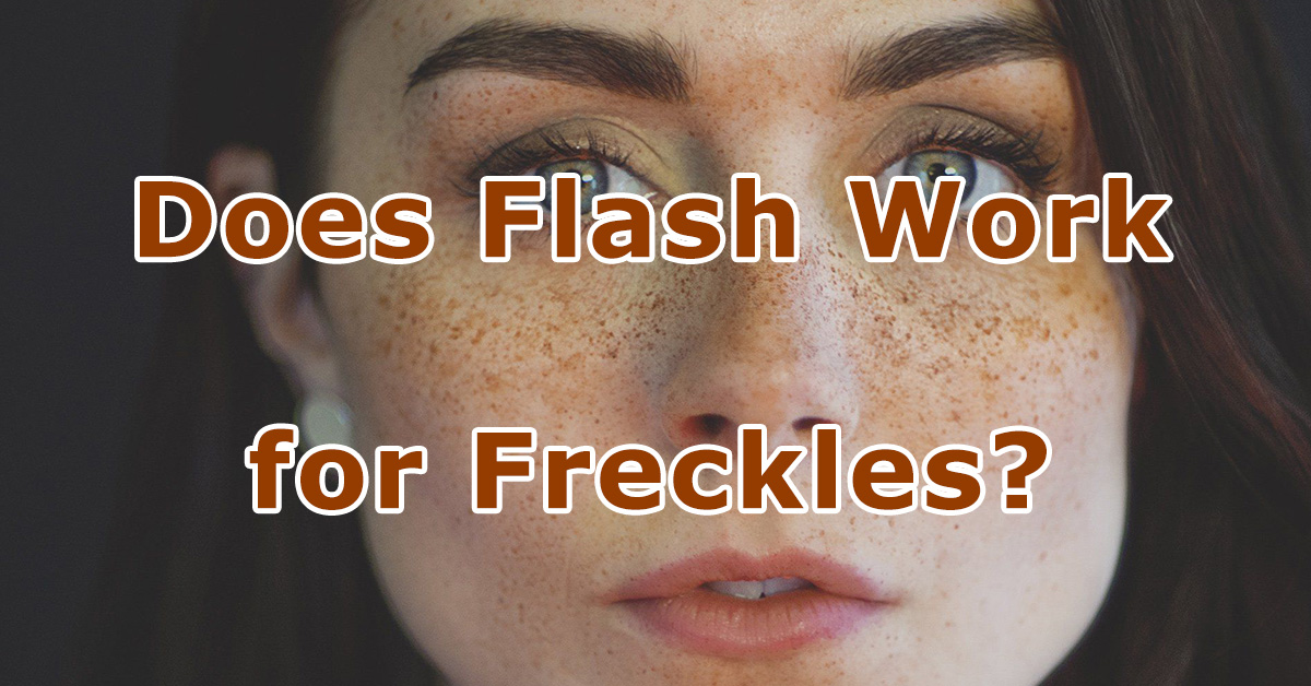 Does Flash Work for Freckles