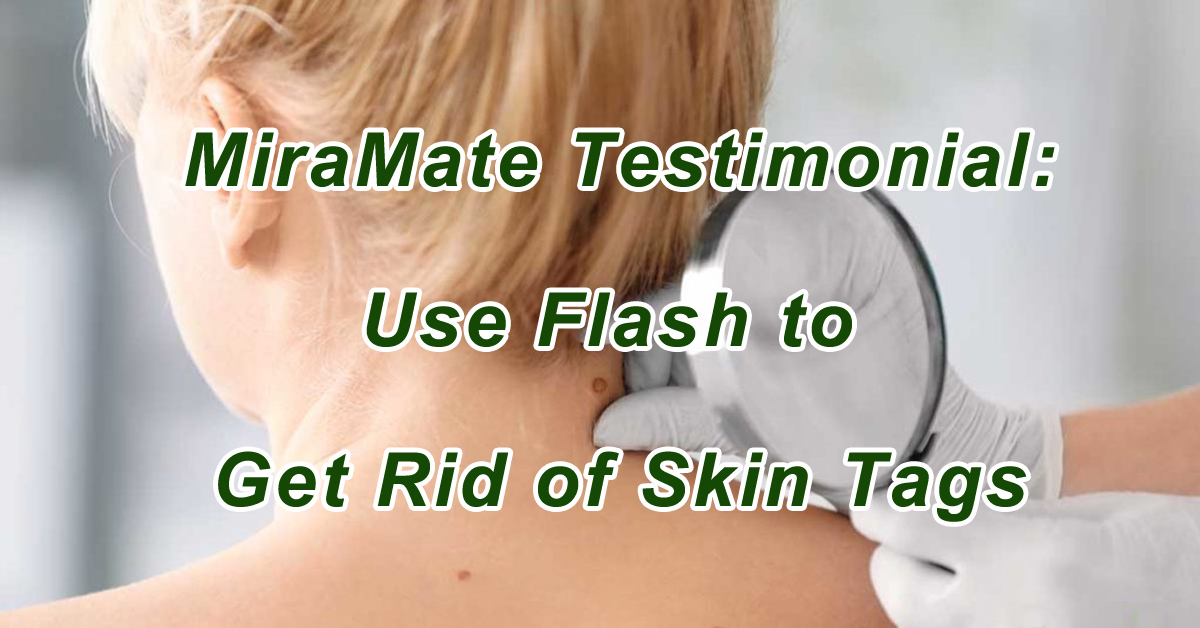 Use Flash to Get Rid of Skin Tags