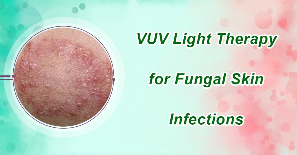 VUV Light Therapy for Fungal Skin Infections