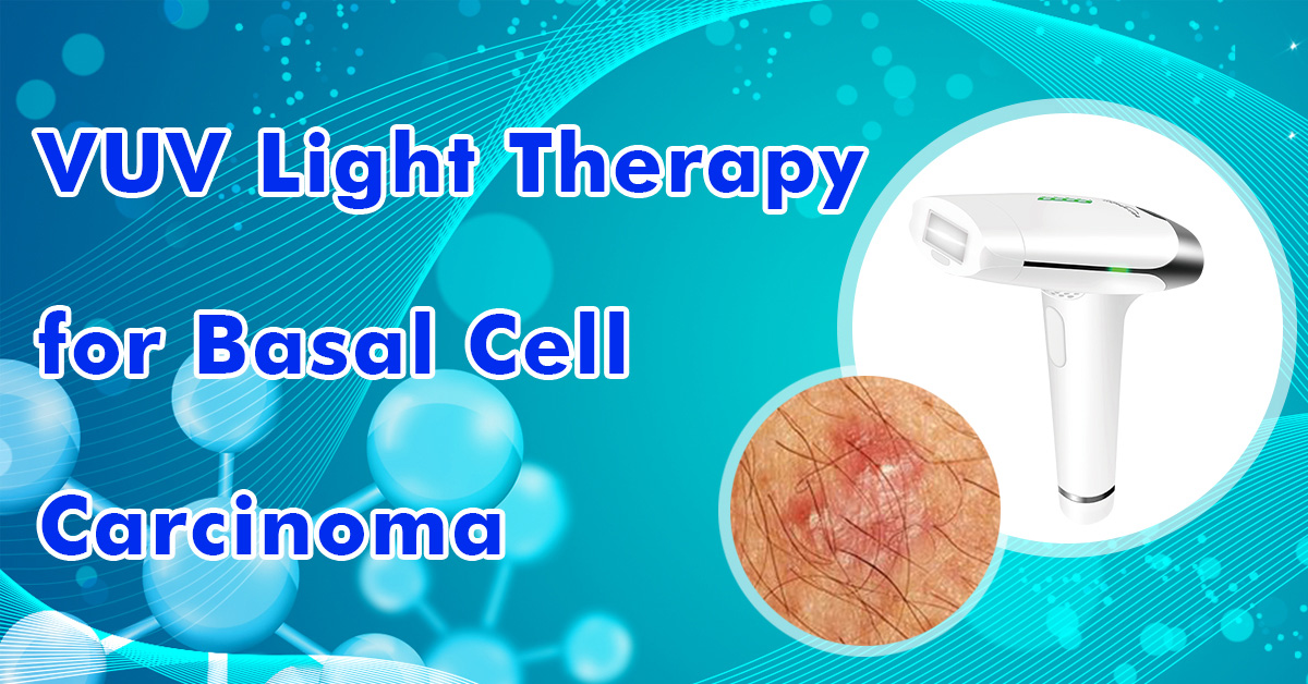 VUV Light Therapy for Basal Cell Carcinoma