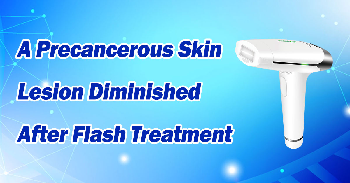 A Precancerous Skin Lesion Diminished After Flash Treatment