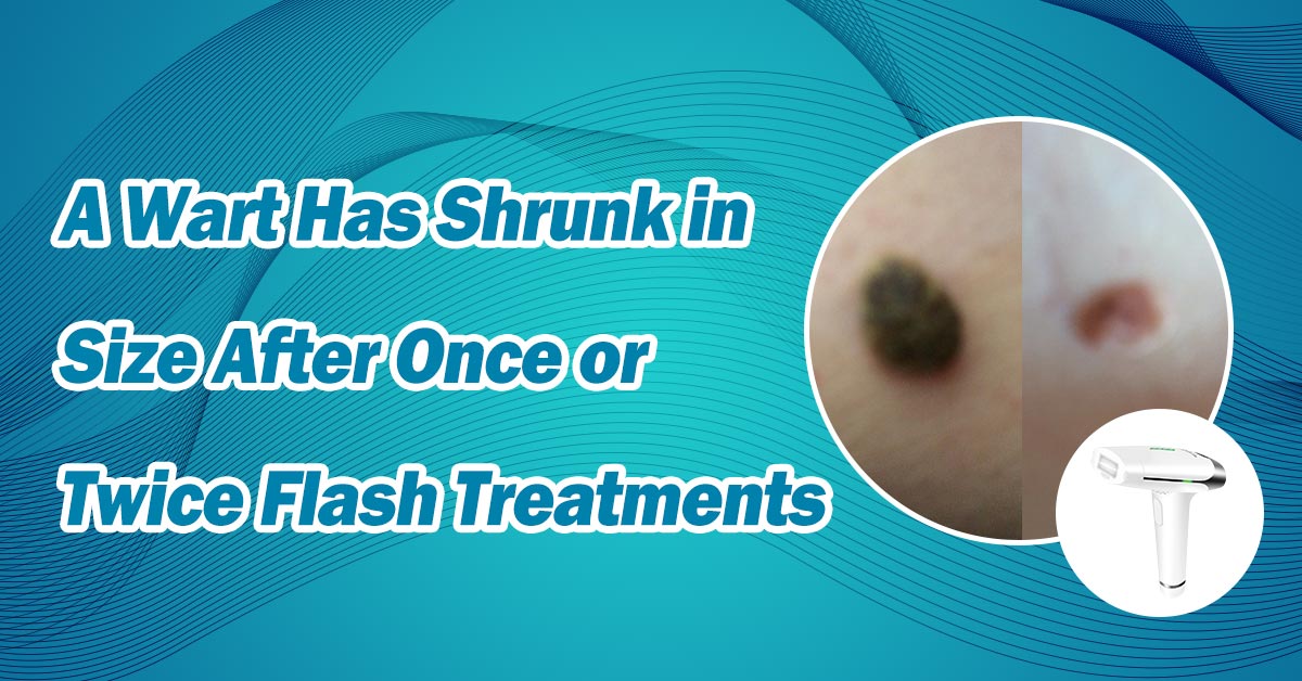 A Wart Has Shrunk in Size After Once or Twice Flash Treatments