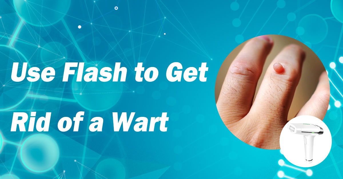 Use Flash to Get Rid of a Wart
