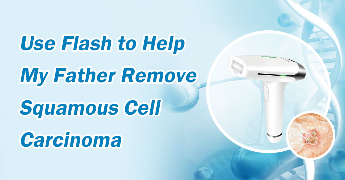 Use Flash to Help My Father Remove Squamous Cell Carcinoma