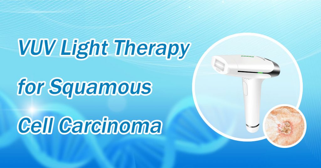 VUV Light Therapy for Squamous Cell Carcinoma