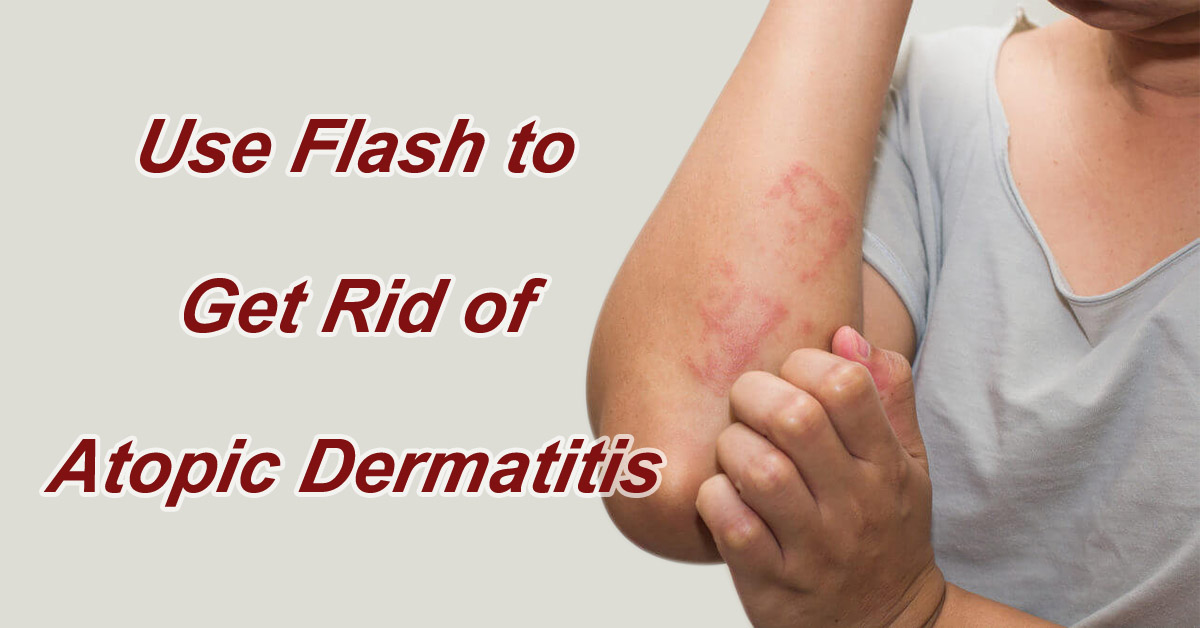 Use Flash to Get Rid of Atopic Dermatitis