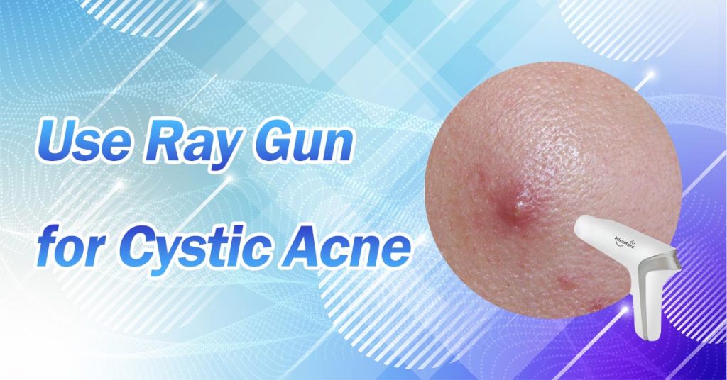 Use Ray Gun for Cystic Acne
