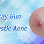 Use Ray Gun for Cystic Acne