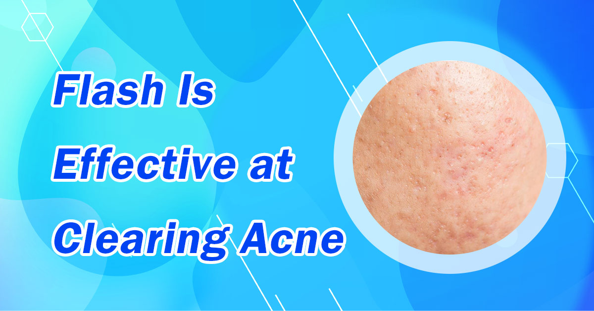 Flash Is Effective at Clearing Acne