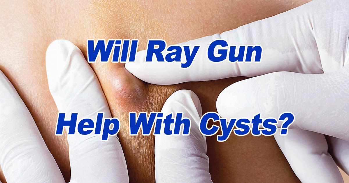 Will Ray Gun Help With Cysts
