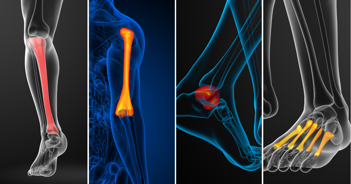 non-union fractures often occur in the tibia, humerus, talus, and fifth metatarsal bone