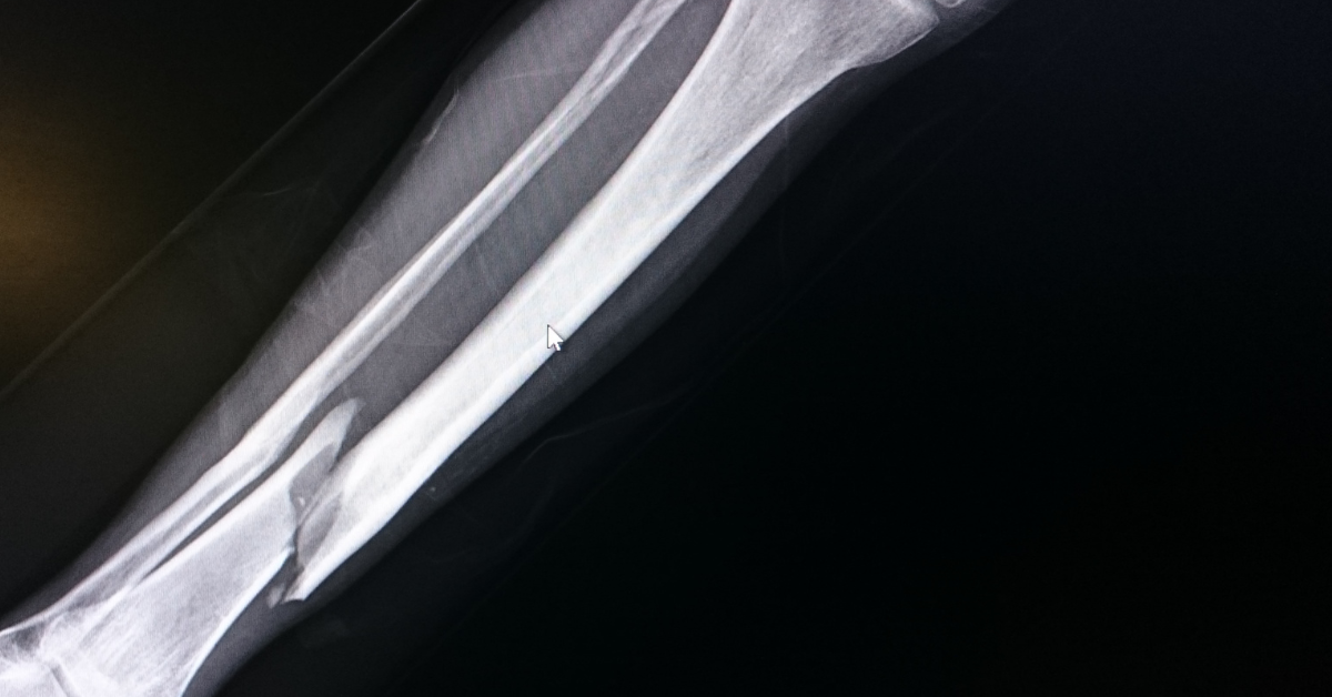 Non-union fractures can be very painful