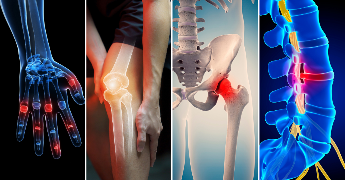 Where can you get osteoarthritis?
