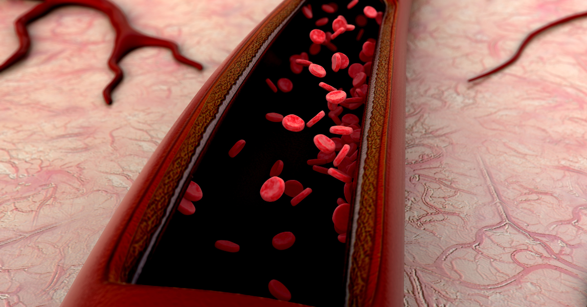 Low Field Magnetic Stimulation therapy helps with atherosclerosis by improving blood circulation